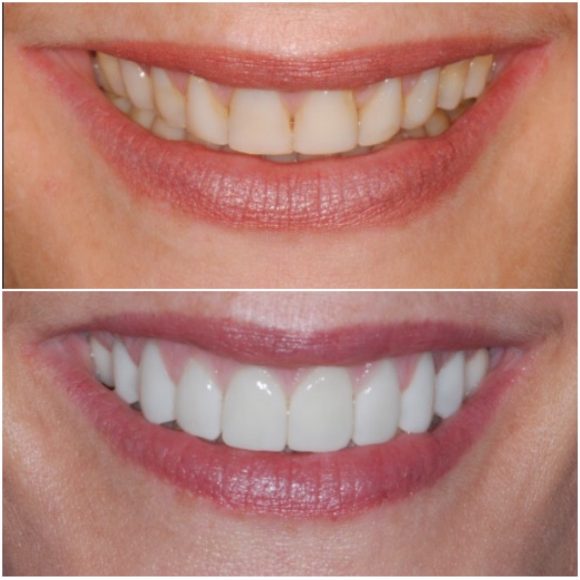 veneers-vorher-nachher